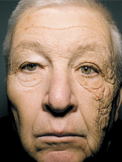 Truck driver sun damage