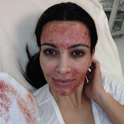 Kim Kardashian Vampire Facial